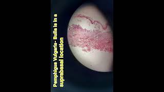 Pemphigus vulgarisdermapathskinbullous diseaseHand Ehistologypathologymedical [upl. by Ratna]