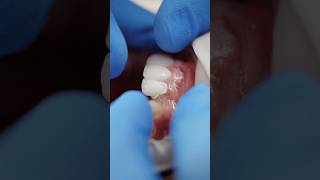 Veneers cementation dentist dentalclinic viralvideo satisfying [upl. by Woolson]