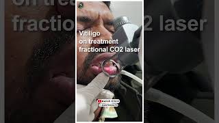 Vitiligo on treatment fractional co2 laser  in Delhi AWISH Clinic [upl. by Rednaxela]