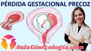 PÉRDIDA GESTACIONAL PRECOZ ABORTO ESPONTÁNEO CAUSAS y DIAGNÓSTICO  Ginecología y Obstetricia [upl. by Eclud]