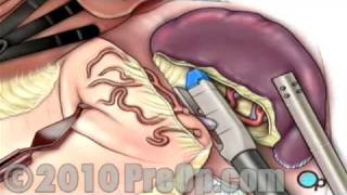 Spleen Removal Laparoscopic PreOp® Patient Education [upl. by Levi]