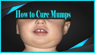 Mumps  What is mumps Mumps symptoms Mumps Treatment  Mumps in Adults and Children [upl. by Akiaki743]