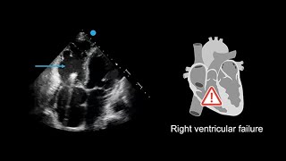 Recognizing poor right ventricular systolic function in echocardiography [upl. by Cassie]