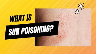 What is sun poisoning [upl. by Nibur]