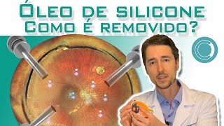 Cirurgia para remoção do óleo de silicone  Retina e Vítreo [upl. by Doralia]