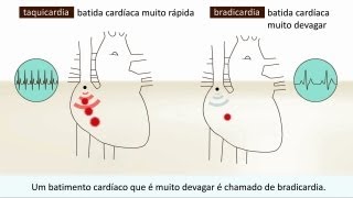 Arritmia  O que é isto [upl. by Tevis]