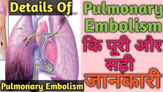 Pulmonary Embolism  Pulmonary Embolism कि पूरी और सही जानकारी और ईलाज। हिंदी में। [upl. by Christian]