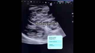 Multiple liver lesion on ultrasound comedy trending baby usgsviralradiologyliveryoutubeusg [upl. by Thurmann528]