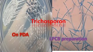 Trichosporon on SDA and LPCB preparation under the microscope [upl. by Shieh640]