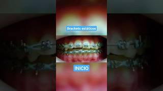 Brackets estéticos 😉 ortodoncistas ortodoncia brackets saludoral dientesperfectos ortodoncista [upl. by Ettenyl]