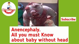 ANENCEPHALY All you must know about baby without Head [upl. by Stafford]