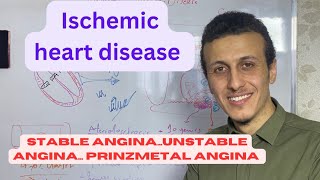 الذبحة الصدرية انواعها واسبابها  angina pec unstable angina prinzmetal angina [upl. by Gelb987]