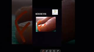 Medicine Koilonychia spoon nail iron deficiency anemia [upl. by Grath]