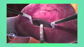 Atrial Septal Defect Repair at SSM Heart Institute [upl. by Wadesworth]