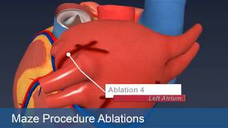 Cardiac Rhythm Disturbances Treatment Options [upl. by Ahsitul]