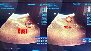 Left Renal Stone Nephrolithiasis with Left Renal Cyst ScanningDiagnosis in Ultrasonography [upl. by Ammon]