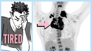 LYMPHOMA After Ignoring 6 WARNING Signs [upl. by Rorke789]