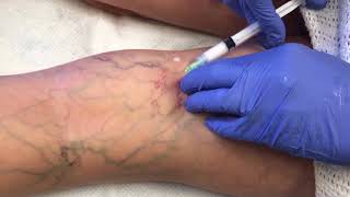 Watch This Vein Disappear  Sclerotherapy Vein Removal [upl. by Anaihk454]