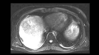 Large hepatocellular carcinoma HCC [upl. by Idnil320]