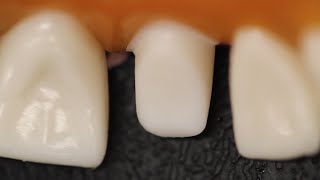 All Ceramic Crown Anterior Tooth Preparation [upl. by Lac870]