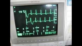 the valsalva maneuver and sinustachycardia  cardiac arrhythmia [upl. by Asselem]