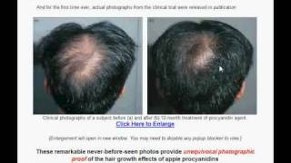 Natural Hair Loss Treatment and Cure [upl. by Wendalyn]