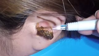 The Most Massive Earwax Removed in One Scoop [upl. by Lednew892]