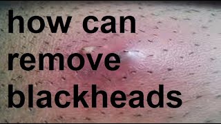 How to remove blackheads [upl. by Ilaw]