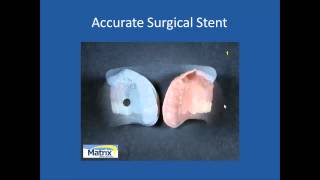 Immediate Denture Surgical Stent Fabrication [upl. by Jobe]