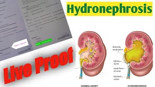 Hydronephrosis Homeopathic Treatment Draravind Homeopathy [upl. by Ainnek]