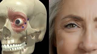 Correct Injection Points for Crows Feet Crows feet Botox Technique [upl. by Togram]