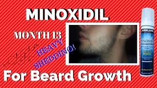 Month 13 Minoxidil Beard Growth Results  IM SHEDDING  GOOD NEWS  TheJourneyContinues [upl. by Myles]