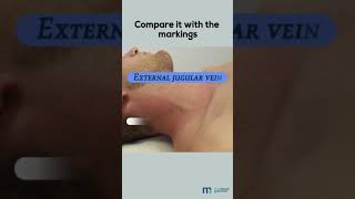 Examination of Jugular Venous Pulse [upl. by Eniamsaj38]