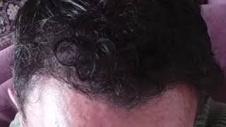 Sapphire Hair Transplant Turkey  Istanbul [upl. by Enenej]