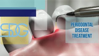 How Does LANAP Work  Periodontal Disease Treatment [upl. by Phip]