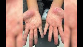 Artificial Turf Gives Kid Second Degree Burns in Minutes [upl. by Gervase]