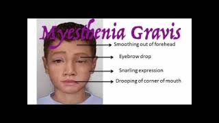 Myasthenia gravis mrcpch Clinical [upl. by Sprage]