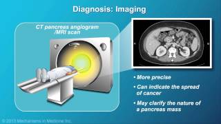 Pancreatic Cancer Pathophysiology Diagnosis and Staging [upl. by Forelli]