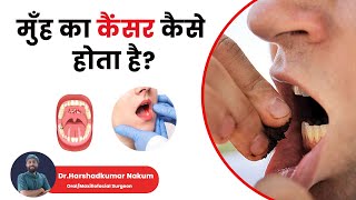 मुंह का कैंसर कैसे होता है जानें मुँह के कैंसर के लक्षण कारण इलाज डॉ से Mouth Cancer in Hindi [upl. by Burwell]