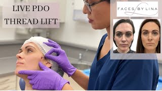 Watch the PDO Thread Lift in Action Say Goodbye to Nasolabial Folds and Marionette Lines [upl. by Anagnos441]