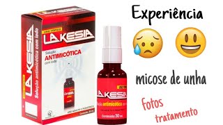 Tratamento com LAKESIA para micose nas unhas minha experiência [upl. by Nnaasil]