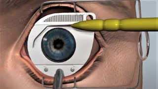 LASIK eye surgery  3D animation [upl. by Koy]