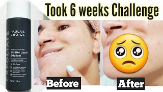 Paulas choice BHA exfoliating Toner Review  6 weeks Live Results ✅ Best BHA   Bhawna Sharma [upl. by Ecnedurp]