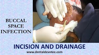 Incision and Drainage of Buccal space infection by Dr Raman Dhungel [upl. by Merchant]