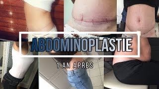 ABDOMINOPLASTIE 1 AN APRES [upl. by Eitteb]