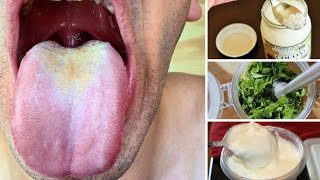 Best Home Remedies for Oral Thrush [upl. by Okier]