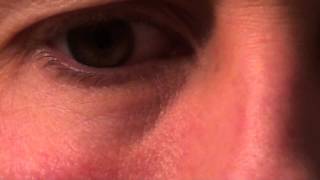 Pulsating vein under eye  why does this happen [upl. by Irol]