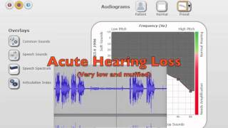 Hearing Loss  What it Sounds Like to Live This Way [upl. by Anirod]