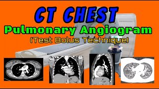 CT Chest Pulmonary Angiogram Test Bolus Technique [upl. by Farl]