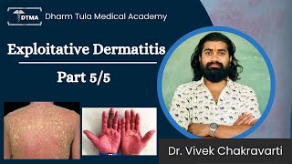 Dermatitis  Exfoliative Dermatitis Hindi  Types  Part 55 Eczema  Skin Disease  Skin Infection [upl. by Ahseniuq35]